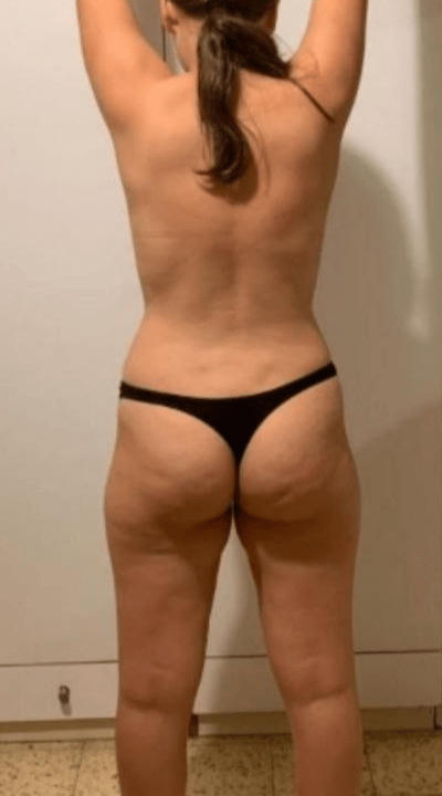 Ручная липоксация до