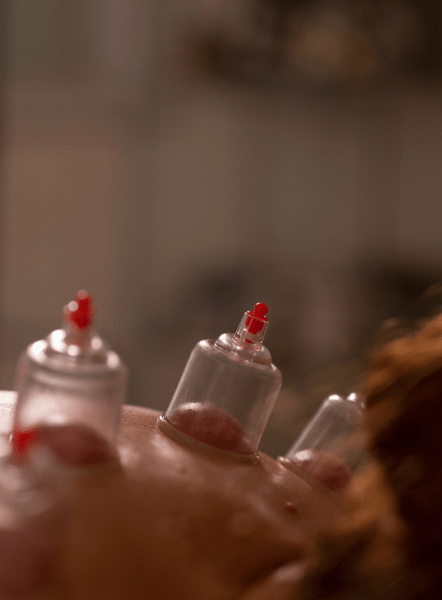 Баночная терапия в процессе